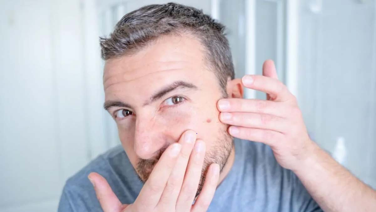 Pimples Home Remedies for men
